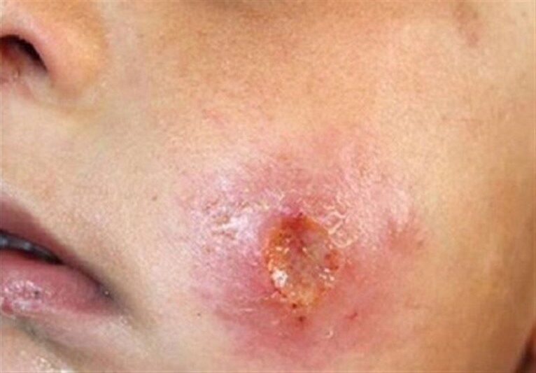 کانون بیماری سالک در ۳۱ روستای مراوهتپه شناسایی شد کانون بیماری سالک در ۳۱ روستای مراوهتپه شناسایی شد