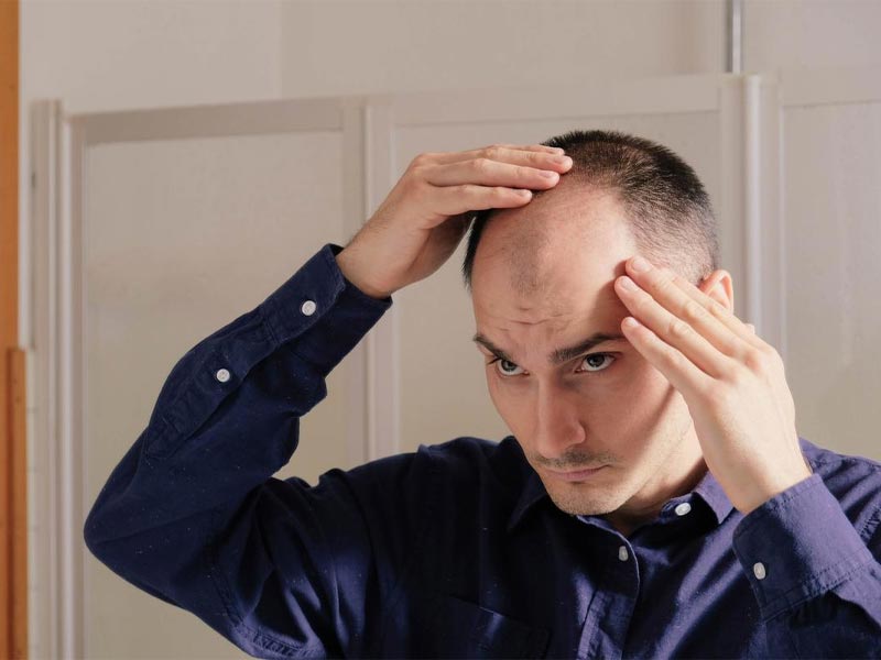 سن مناسب برای کاشت موی طبیعی سن مناسب برای کاشت موی طبیعی