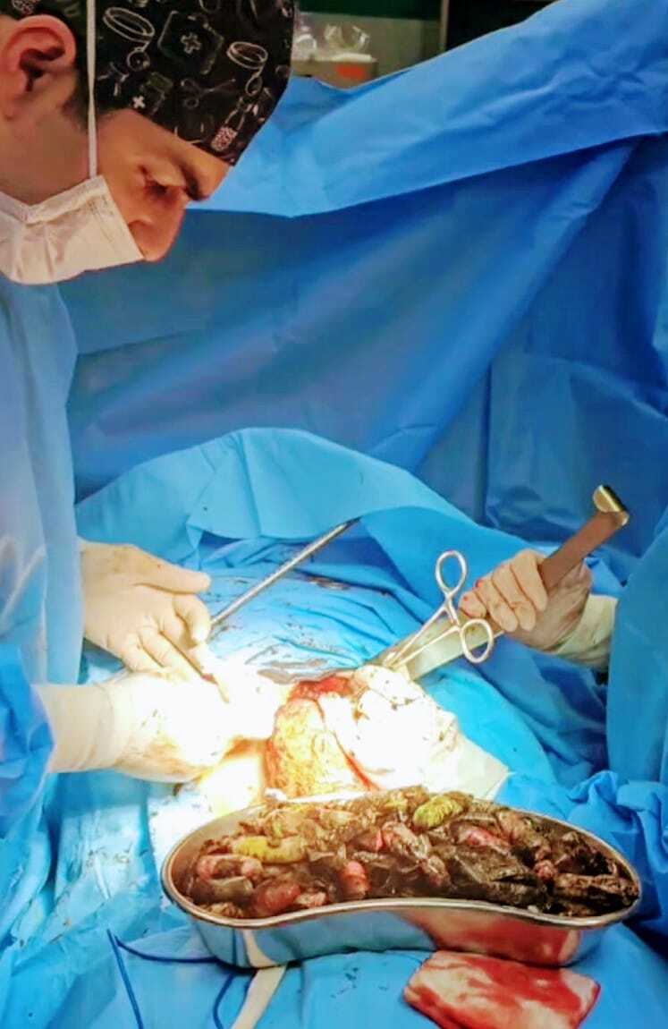 خروج ۹۰ بسته مواد مخدر از معده و روده بیماری در کرج 