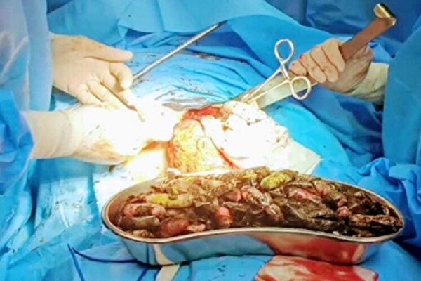 خروج ۹۰ بسته مواد مخدر از معده و روده بیماری در کرج 